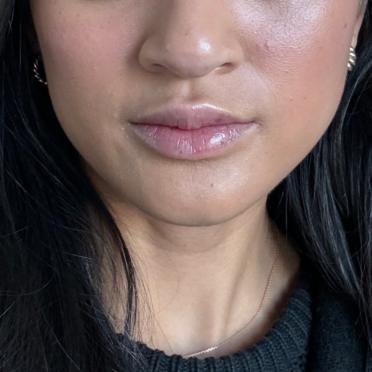 Lip filler swelling, day 2-3